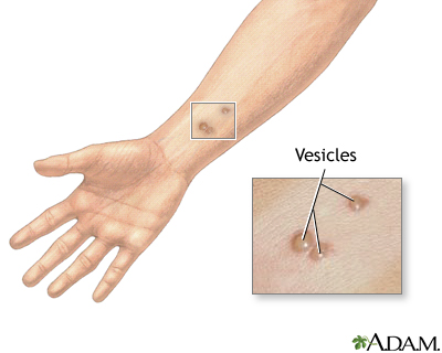 Vesicles