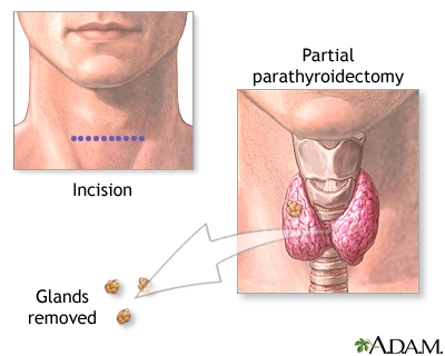 Parathyroidectomy