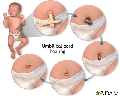 Umbilical care