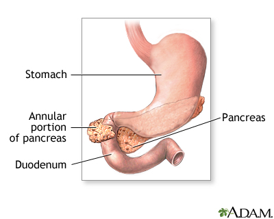 Annular pancreas