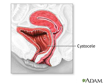 Cystocele