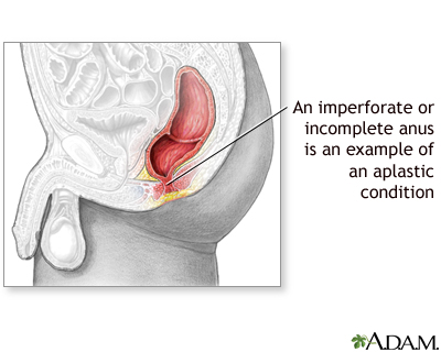 Aplastic condition