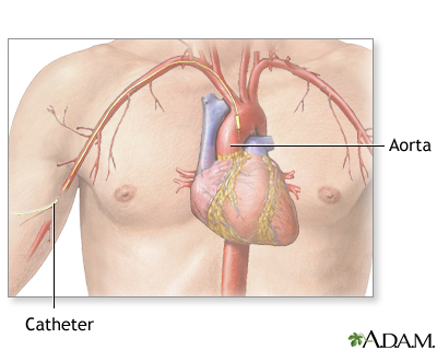 Cardiac arteriogram