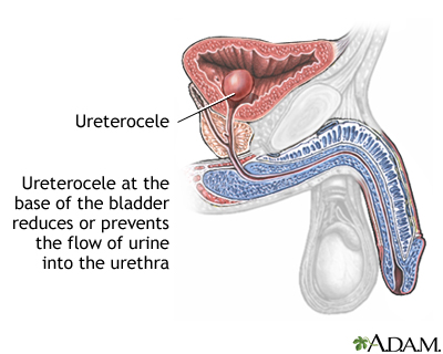 Ureterocele