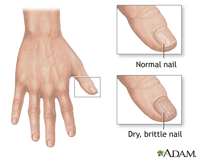 Brittle nails