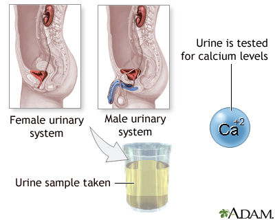 Calcium urine test