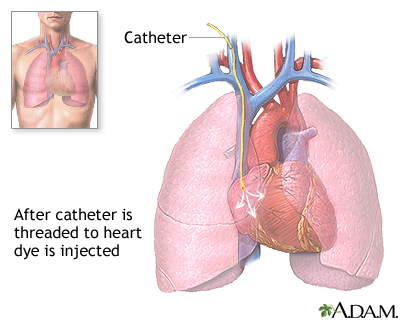 Cardiac catheterization