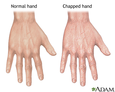 Chapped hands