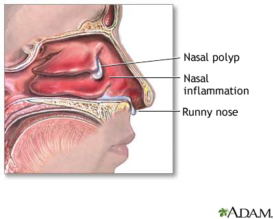 Nasal polyps