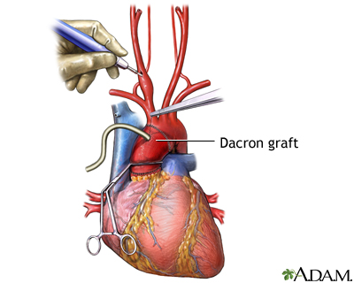 Dacron graft placement