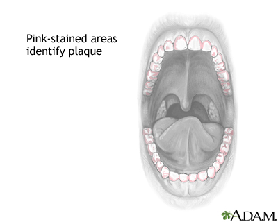 Dental plaque stain