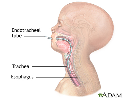 Endotracheal intubation