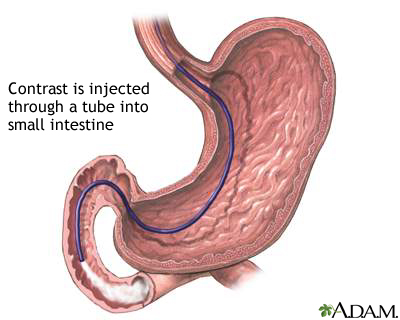 Small intestine contrast injection