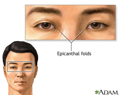 Epicanthal folds