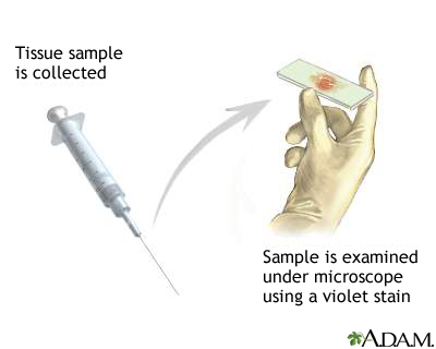 Gram stain of tissue biopsy