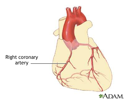 Coronary artery disease