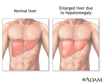 Hepatomegaly