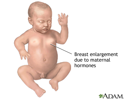 Hormonal effects in newborns