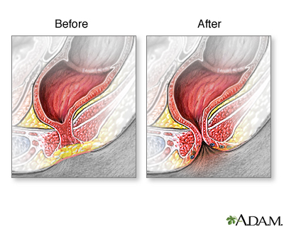 Imperforate anus