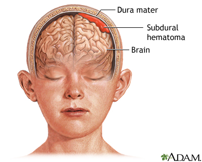 Subdural hematoma