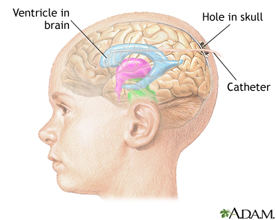 Intracranial pressure monitoring