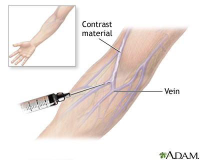 Intravenous pyelogram