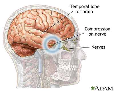 Brain hernia