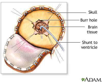 Craniotomy for cerebral shunt