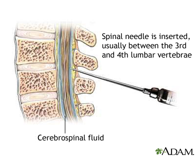 Lumbar puncture