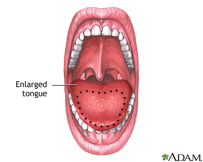 Macroglossia