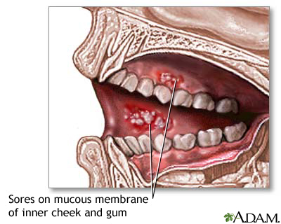 Mouth sores