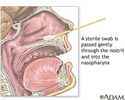 Nasopharyngeal culture