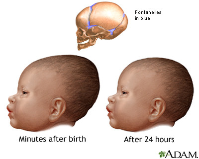 Newborn head molding