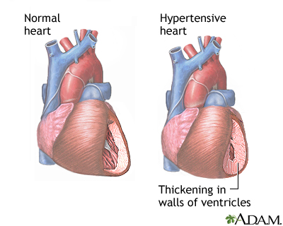 Hypertension