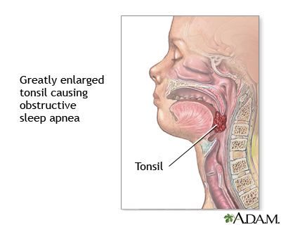 Obstructive sleep apnea