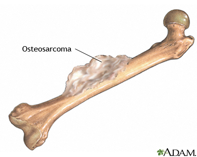 Bone tumor