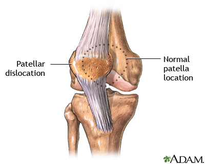 Patellar dislocation