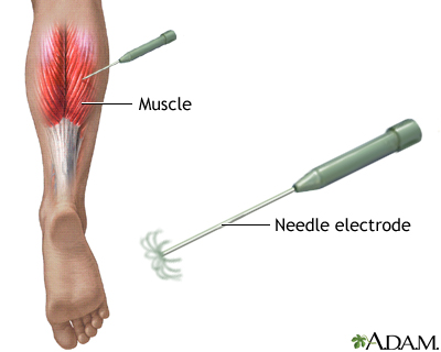 Electromyography