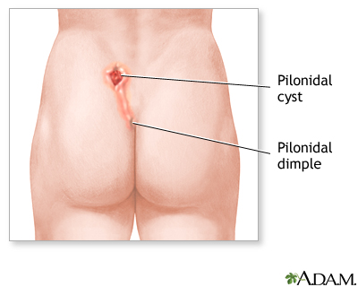 Pilonidal cyst and dimple