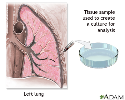 Pleural culture