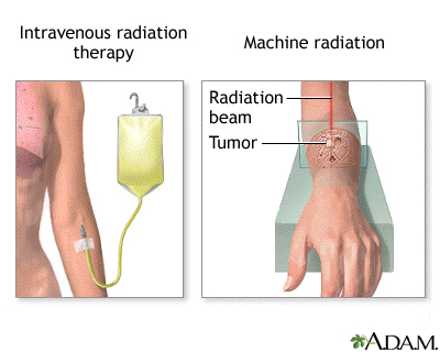 Radiation therapy