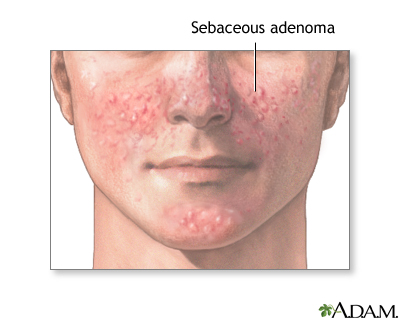 Sebaceous adenoma