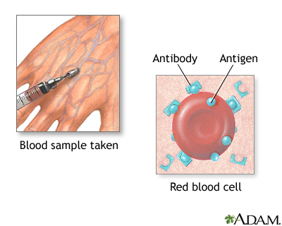 Herpes biopsy