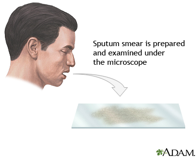 Sputum test