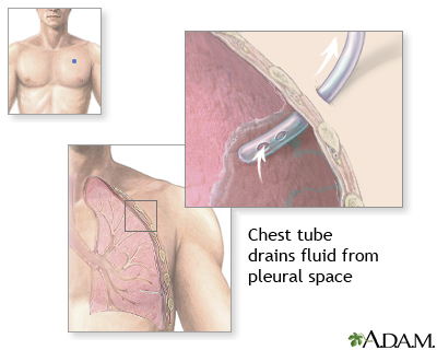 Chest tube insertion