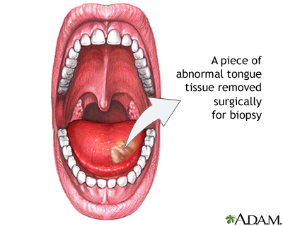 Tongue biopsy