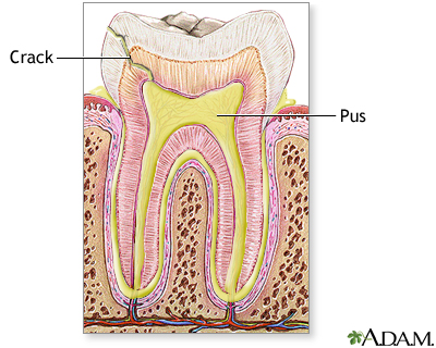 Tooth abscess