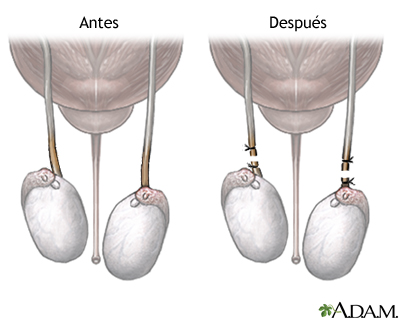 Antes y después de la vasectomía