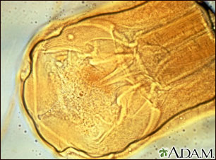 Primer plano de un anquilostoma