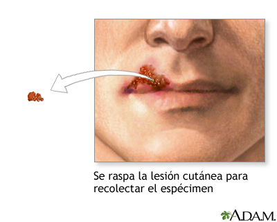 Cultivo de una lesión viral